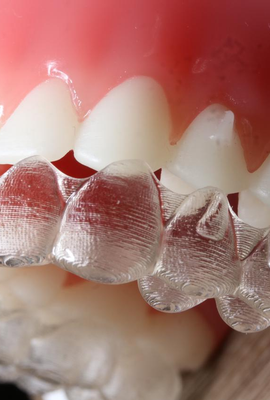 Além da estética: alinhadores transparentes são mais práticos e higiênicos 